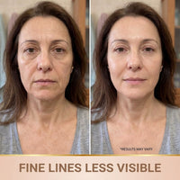 Fine lines less visible