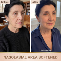 Nasolabial area softened